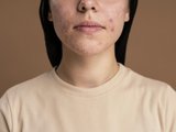Черные точки угри прыщи Черные точки угри прыщи