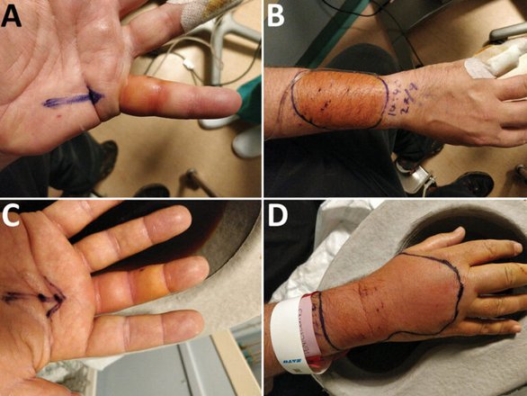 Инфицированная рука и предплечье британца. Фото: Jones et al., Emerging Infectious Diseases, 2023