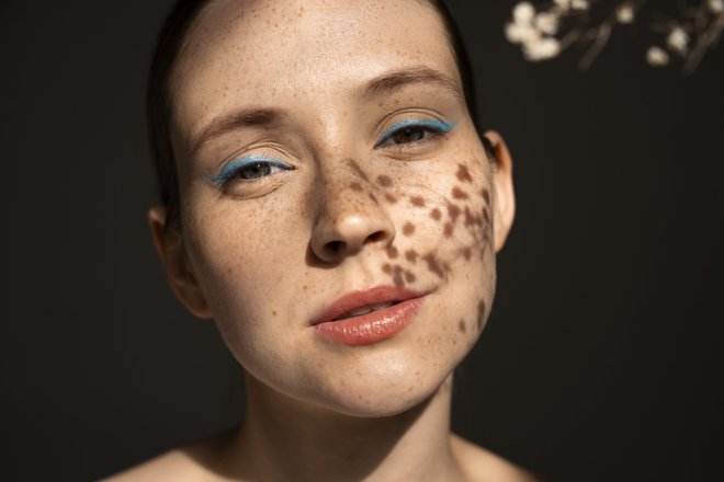 acne2 acne2