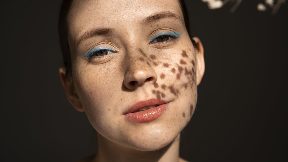 acne2 acne2