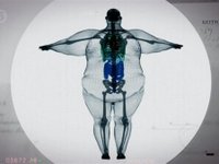 Content image for: 482881 | Рентген человека весом более 200 кг. Как видим, ширина кости вполне стандартная