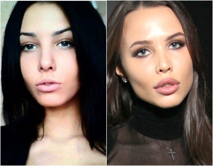 Анастасия Решетова до и после пластики Анастасия Решетова до и после пластики