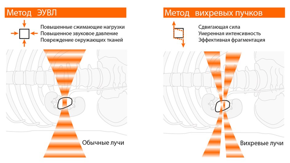 Сравнение метода ЭУВЛ с новой технологией Сравнение метода ЭУВЛ с новой технологией