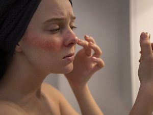 Чувствительная кожа лица, раздражение
