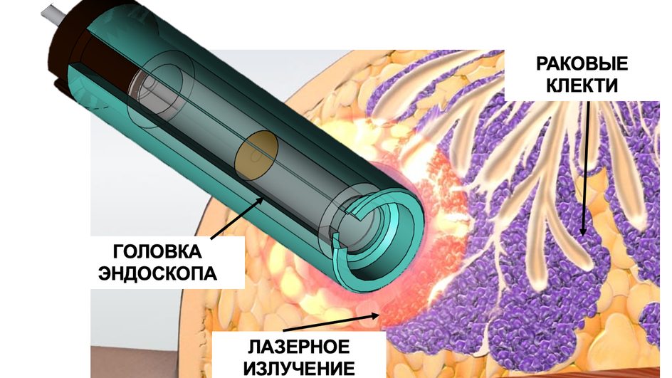 3D-модель объектива малоинвазивного эндоскопа для лечения онкологических заболеваний органов ЖКТ 3D-модель объектива малоинвазивного эндоскопа для лечения онкологических заболеваний органов ЖКТ