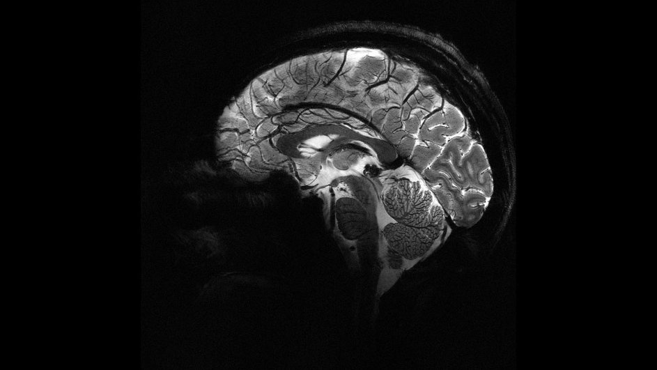 МРТ мозга
