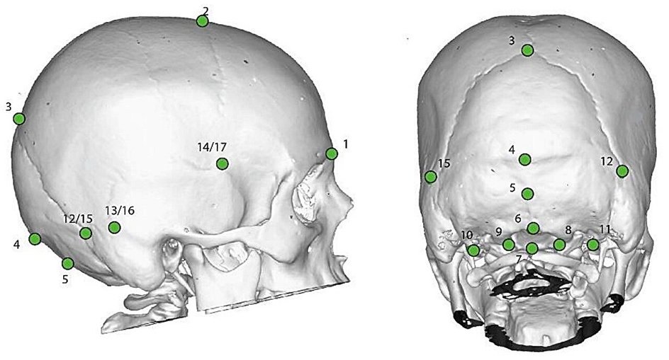 3D-модель черепа, полученная методом КТ 3D-модель черепа, полученная методом КТ