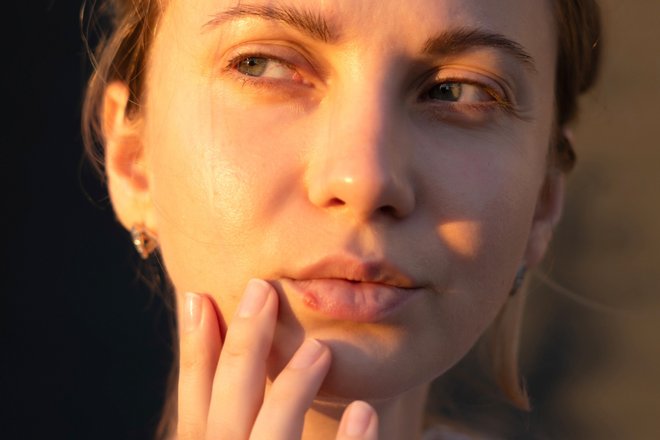 Дерматовенеролог рассказала, как быстрее вылечить герпес Дерматовенеролог рассказала, как быстрее вылечить герпес