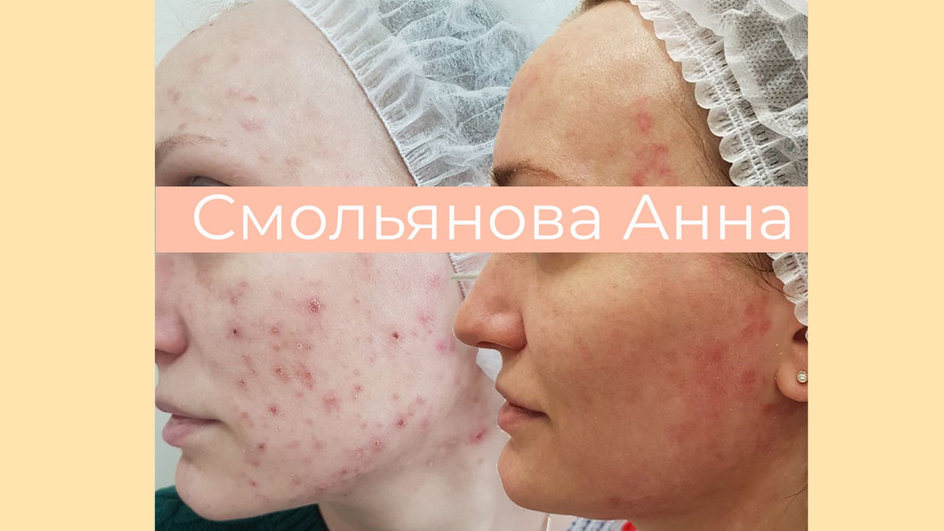 Кожа лица до и после фотоомоложения Кожа лица до и после фотоомоложения