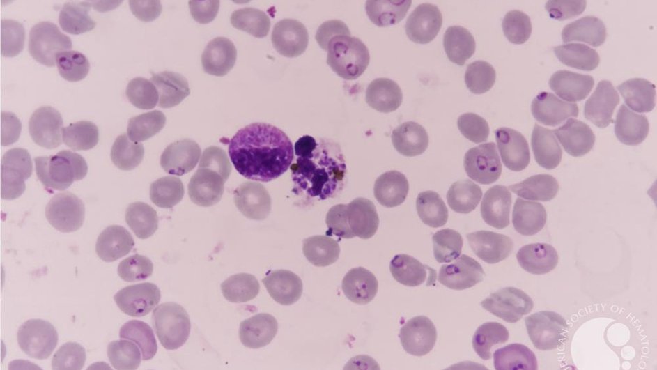 Исследователи выяснили, как паразит Plasmodium falciparum, вызывающий малярию, способен скрываться в организме человека в течение многих лет Исследователи выяснили, как паразит Plasmodium falciparum, вызывающий малярию, способен скрываться в организме человека в течение многих лет