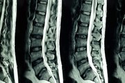 Spinal Cord MRI