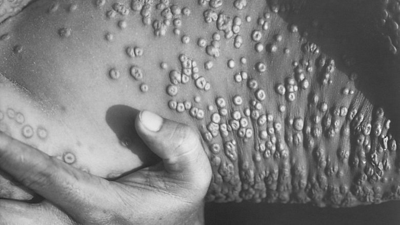 Тело больного оспой. Фото: BBC