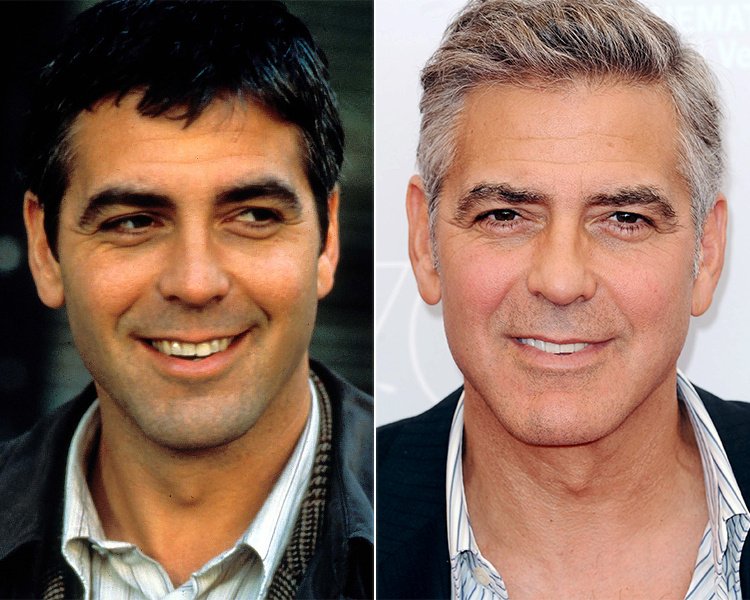 Джордж Клуни, по мнению нашего эксперта, корректирует морщины в области лба