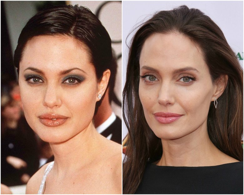 Фактурное лицо Анджелины Джоли чаще всего приводят в пример, говоря об удалении комков Биша и его последствиях.