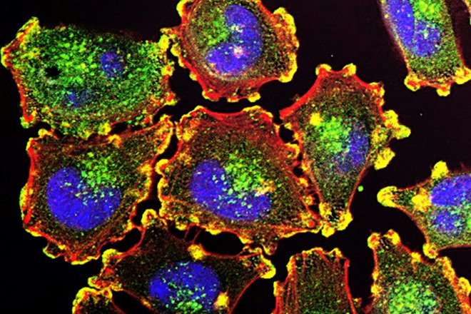 Melanoma Cells Melanoma Cells