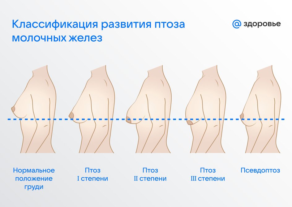 Классификация развития птоза молочных желез