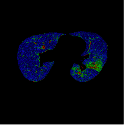 КТ-снимок органов грудной клетки и головного мозга
