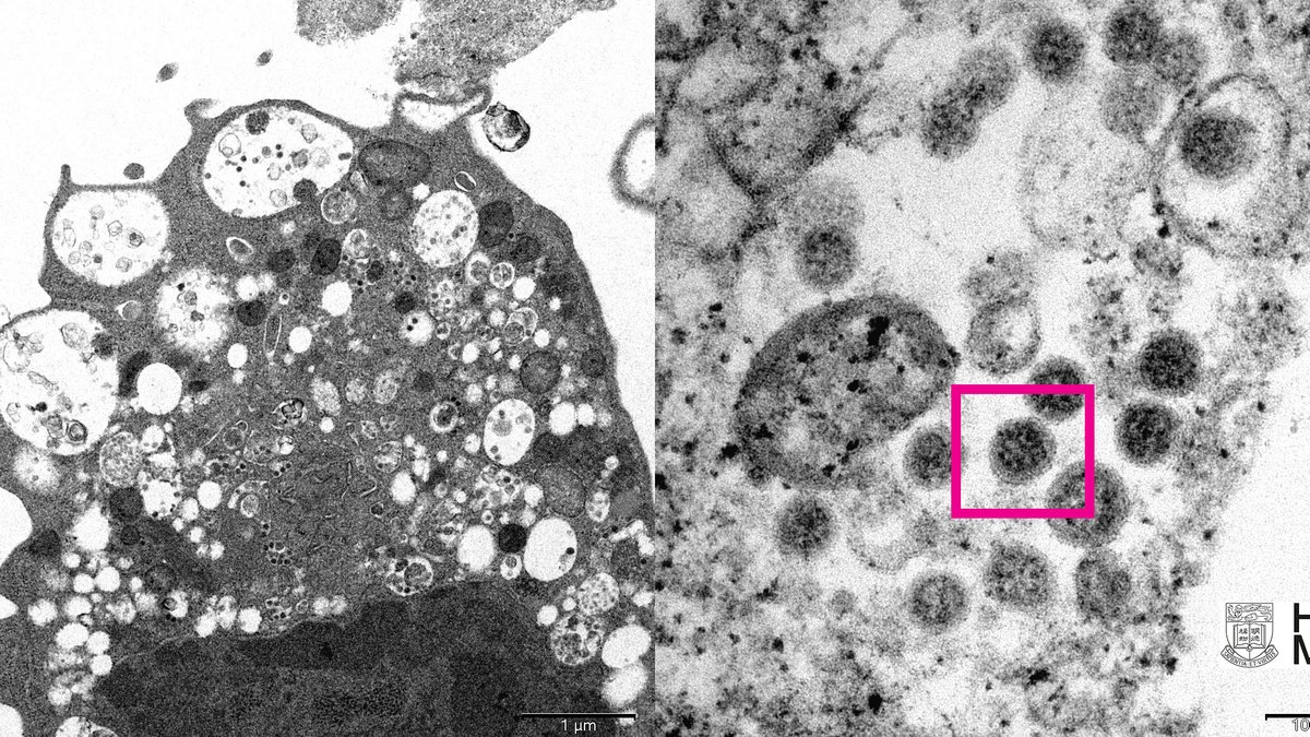 Human coronavirus. Manifestations. Symptoms Treatment. Photo.