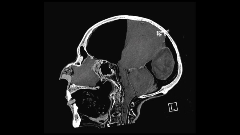 Компьютерная томограмма черепа Рамсеса II.